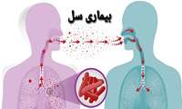 دانستی های در مورد بیماری سل